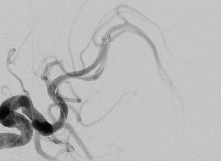 Angiografía cerebral. Wikimedia